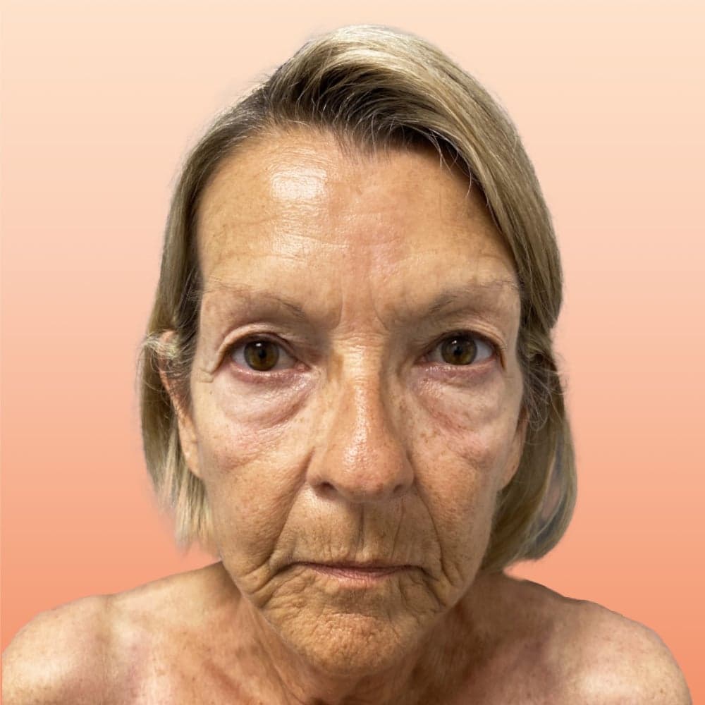 Avant — patiente traitée pour un lifting visage et cou